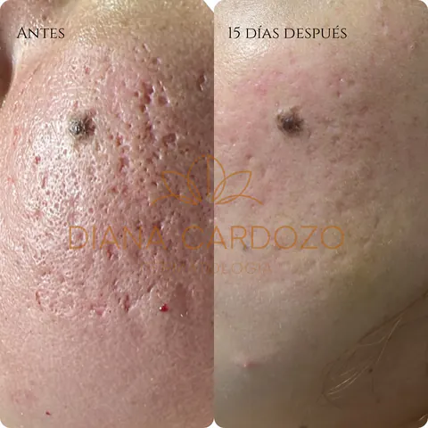Antes y después: cicatrices de acné