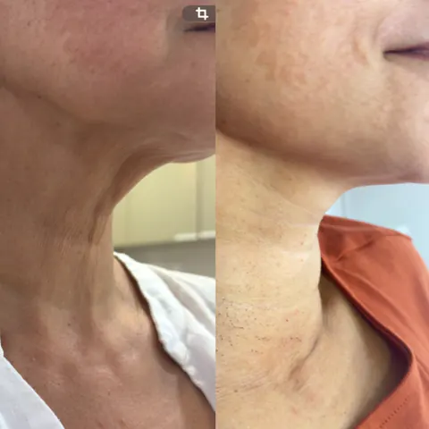 Rejuvenecimiento de cuello con láser