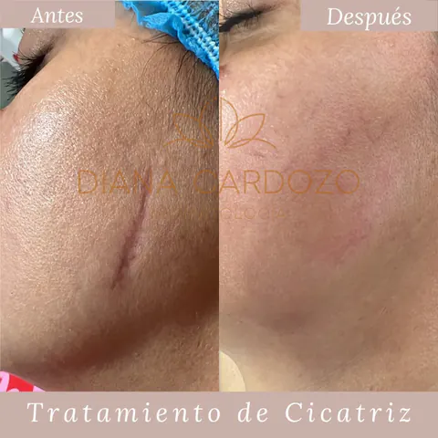 Tratamiento de cicatriz atrófica