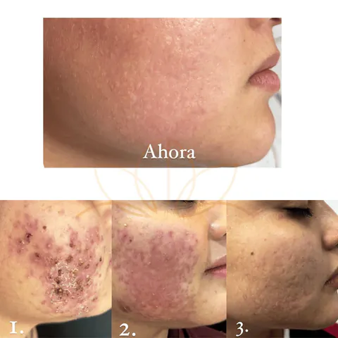 Evolución del tratamiento del acné